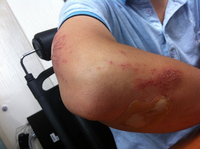 soft tissue shoulder injury
